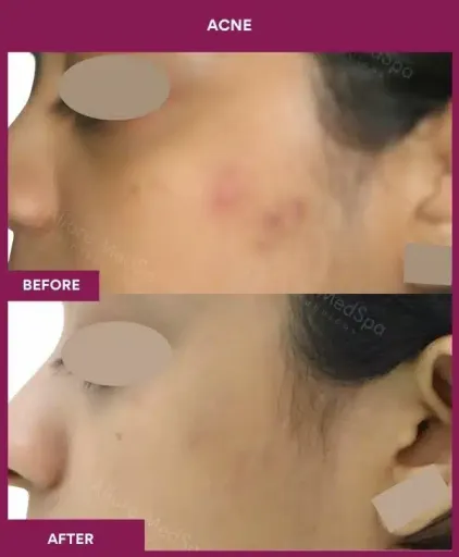 2 Acne Treatment (2)