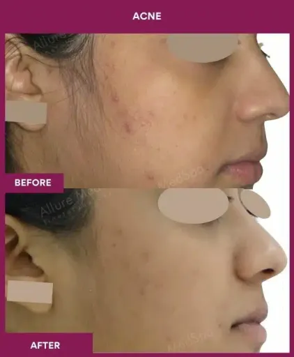 2 Acne Treatment (3)