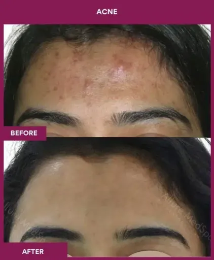 2 Acne Treatment