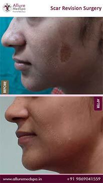 Scar Removal Treatment: See Real Results Before and After