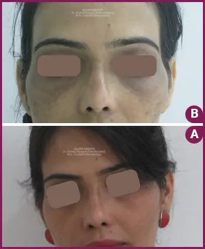 Comparison of pigmentation treatment results: Before and after 