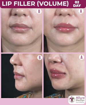 lip filler treatment result to increase the volume at the best cost in Andheri west, mumbai