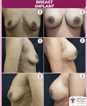 Sides comparison of before and after breast implant surgery results done in mumbai
