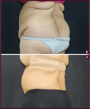 BELT-PLASTY-Large-BEFORE AND AFTER PICTURES