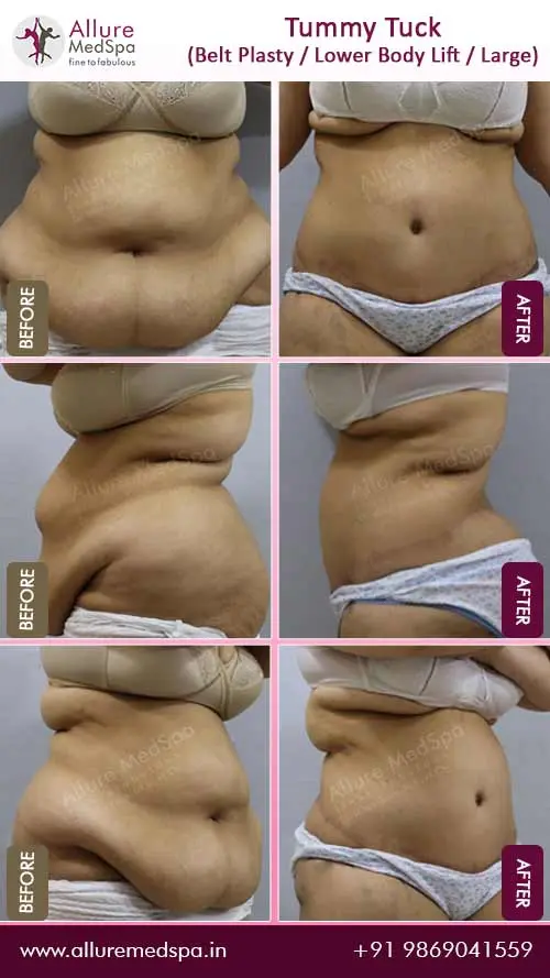Belt-Plasty-Before-and-After-Pictures