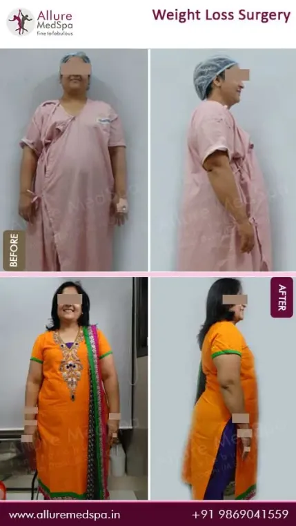 Bariatric-Surgery-Before-and-After-Photos-in-Mumbai-India