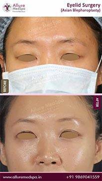 Blepharoplasty-Before-and-After-Gallery-in-Mumbai-India
