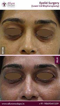 Blepharoplasty-Before-and-After-Images-in-Mumbai-India