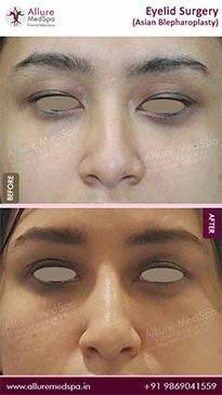 Blepharoplasty-Before-and-After-Result-in-Mumbai-India