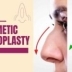 Cosmetic rhinoplasty