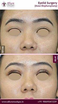 Eyelid-Surgery-Before-and-After-Pictures-in-Mumbai-India