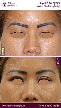 Laser-Eyelid-Surgery-Before-and-After-Gallery-in-Mumbai-India