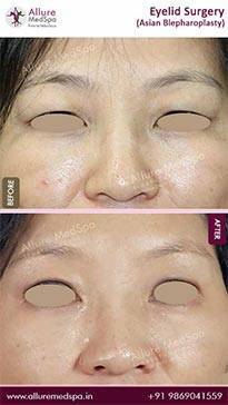 Laser-Eyelid-Surgery-Before-and-After-Photos-in-Mumbai-India