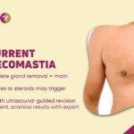 Recurrent Gynecomastia Why It Happens & How to Fix It Permanently