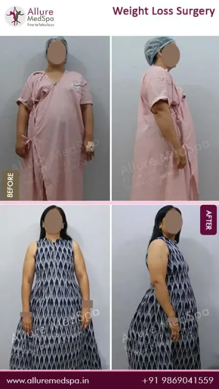 Weight-Loss-Surgery-Before-and-After-Pictures-in-Mumbai-India