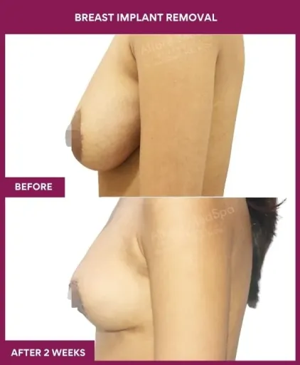 1- Breast implant removal_3_ (3)