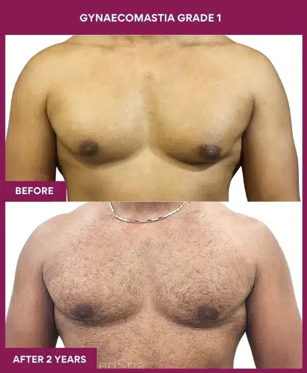 1-GYNAECOMASTIA GRADE 1