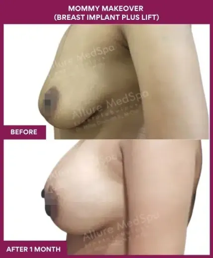 1 Mommy Makeover (BREAST LIFT)_37 (2)