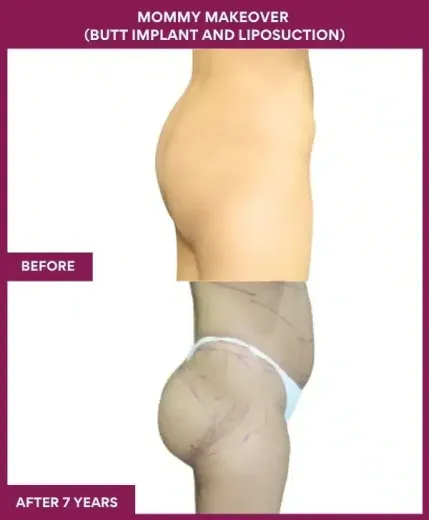 1 Mommy Makeover (BUTT IMPLANT AND LIPOSUCTION)_61 (2)