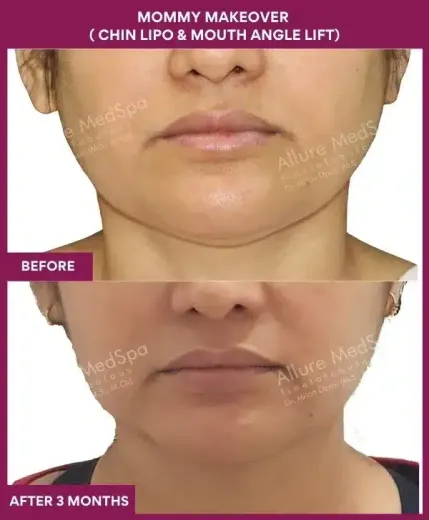 1 Mommy Makeover ( Chin Lipo & Mouth Angle Lift) (4)_79