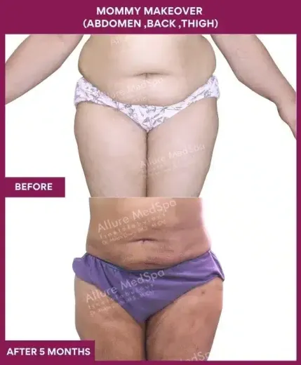 1 Mommy Makeover ( MEGALIPOSUCTION -ABDOMEN ,BACK ,THIGH) (4)_151