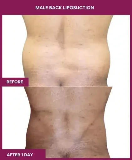12-Male Back liposuction