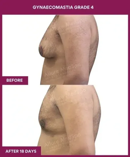 13- GYNAECOMASTIA GRADE 4_