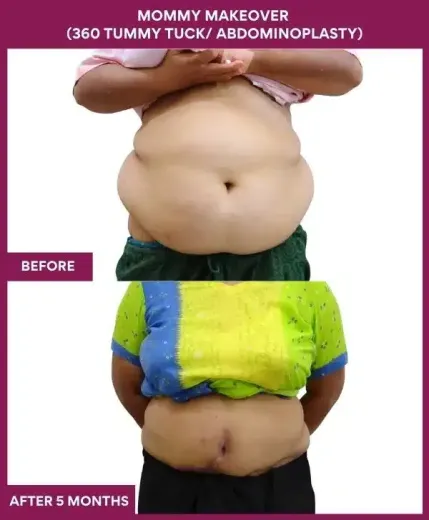 14 Mommy Makeover (360 TUMMY TUCK_ ABDOMINOPLASTY)_148 (1)