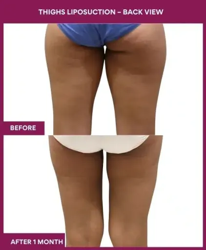 18 Thighs Liposuction – Back View
