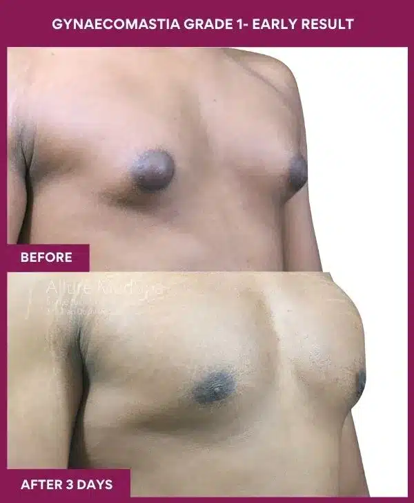 2- GYNAECOMASTIA GRADE 1- EARLY RESULT