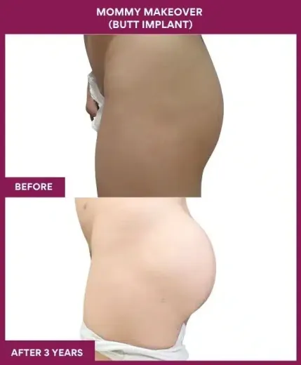 2 Mommy Makeover (BUTT IMPLANT)BUTT IMPLANT_64 (2)