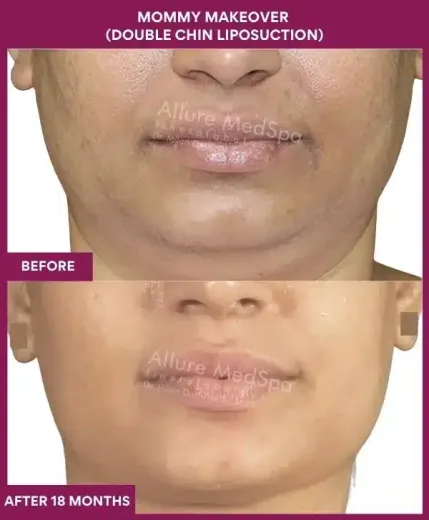 2 Mommy Makeover (DOUBLE CHIN LIPOSUCTION) (4)_82