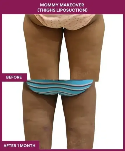 2 Mommy Makeover (Thighs Liposuction)_99 (2)