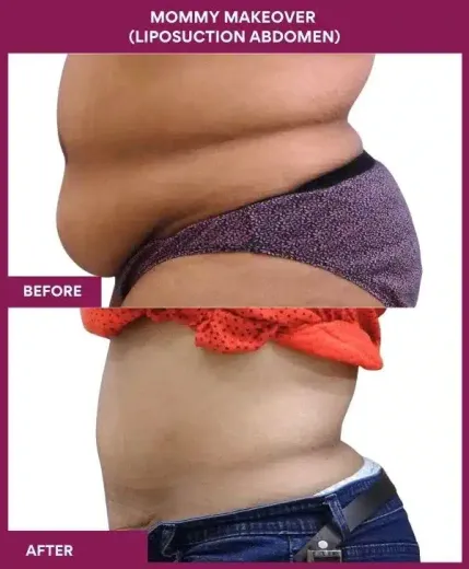 2 Mommy Makeover (liposuction abdomen)_155 (3)