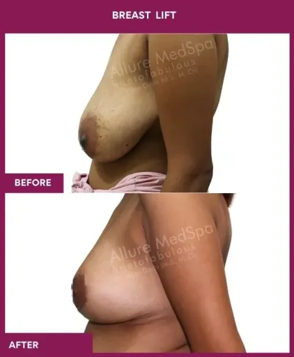 2 breast lift_6_ (3)