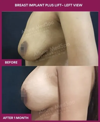 3 BREAST IMPLANT PLUS LIFT– Left View_8