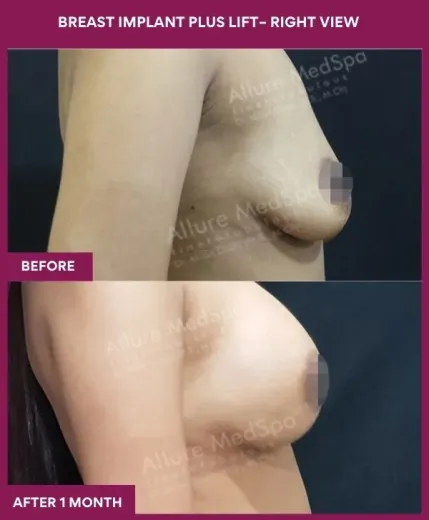 3 BREAST IMPLANT PLUS LIFT– RIGHT VIEW_9