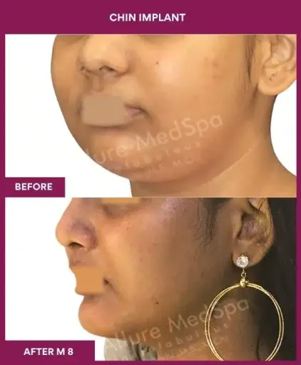 3 Chin Implant in Mumbai, India