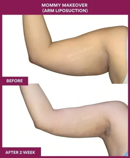 3 Mommy Makeover (Arm Liposuction)_6 (1)