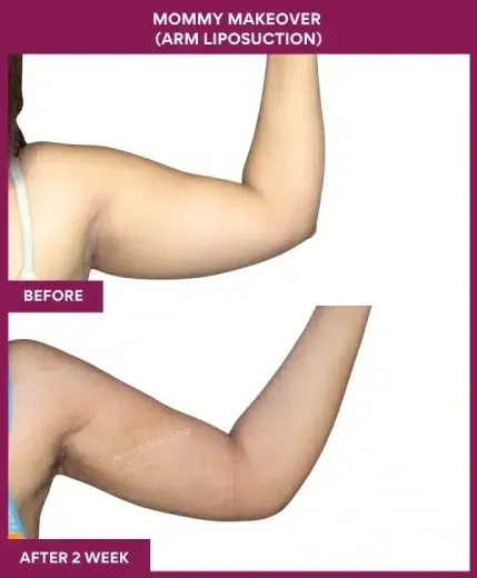 3 Mommy Makeover (Arm Liposuction)_6 (2)