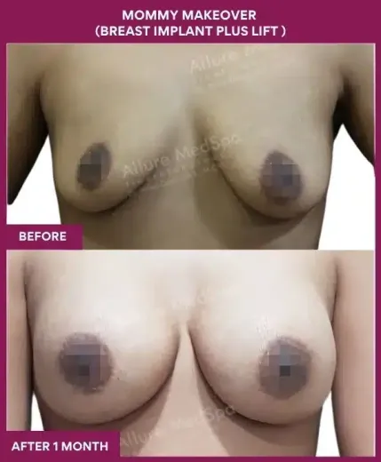 3 Mommy Makeover (BREAST IMPLANT PLUS LIFT ) (4)_