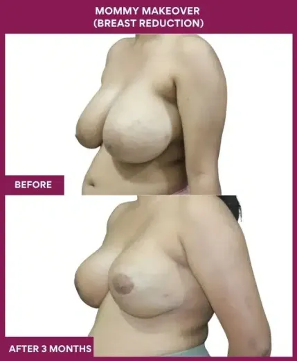 3 Mommy Makeover (Breast Reduction)_55 (3)