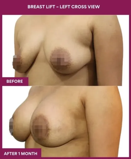 3Breast Lift – left Cross View_9