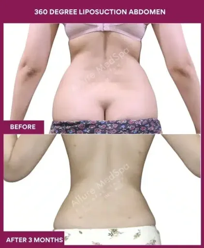 4- 360 DEGREE LIPOSUCTION ABDOMEN--