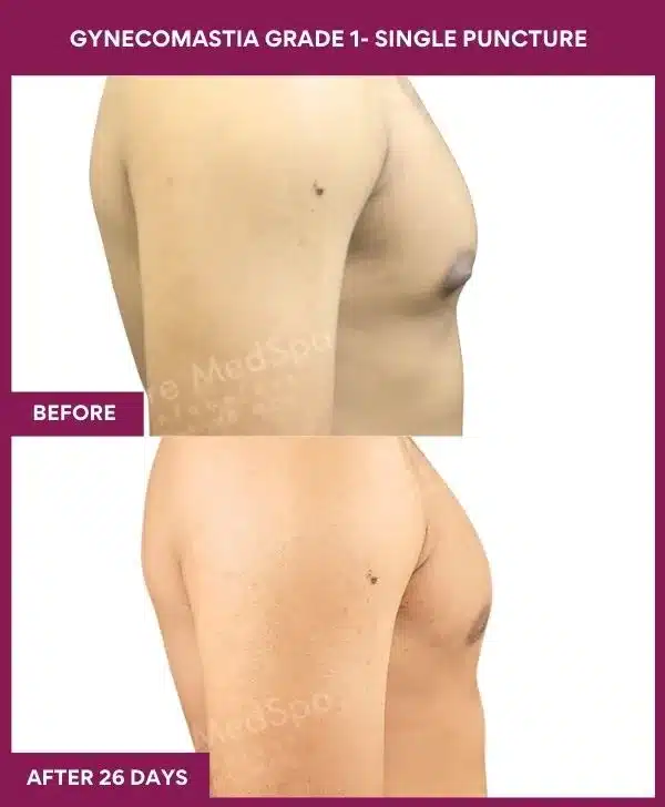 4- Gynecomastia grade 1- Single Puncture (2)