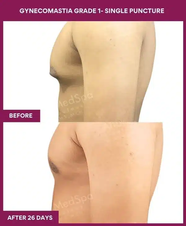 4- Gynecomastia grade 1- Single Puncture (3)