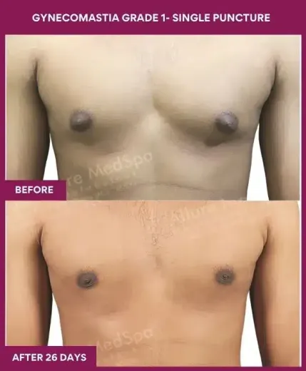 4- Gynecomastia grade 1- Single Puncture_