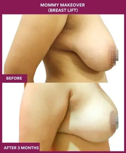 4 Mommy Makeover (BREAST LIFT)_46 (2)