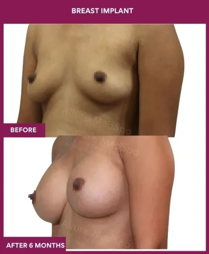5 Breast implant_14_ (3)