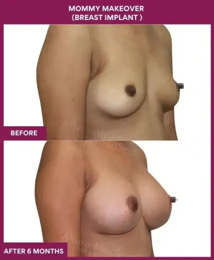5 Mommy Makeover (Breast implant )_25 (1)